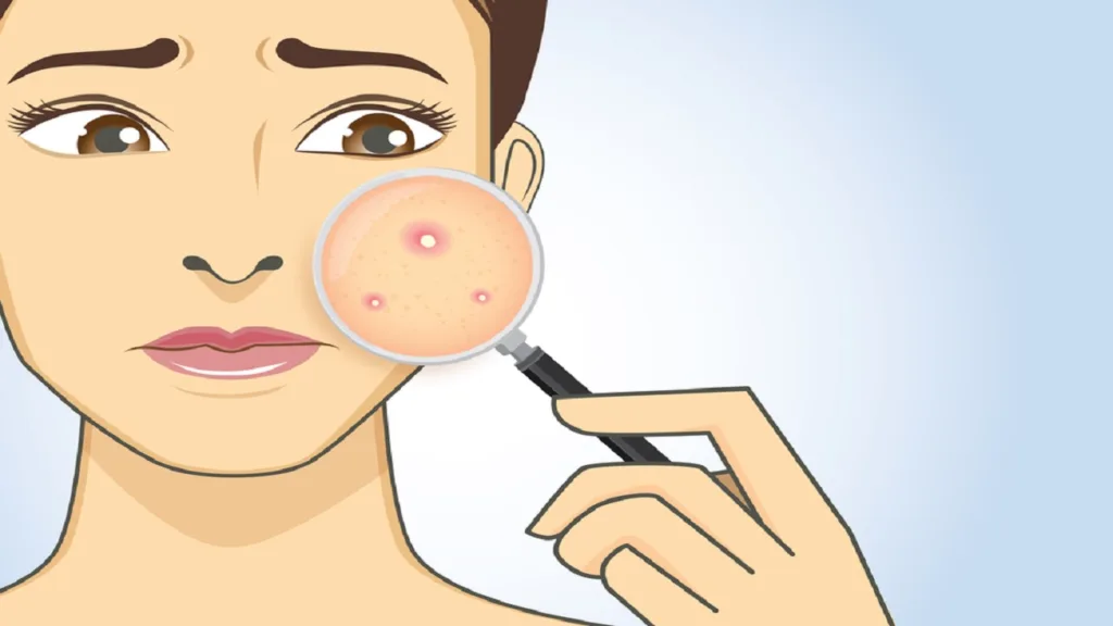 What helps against pimples? The most effective tips to get rid of annoying impurities