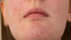 Featured image for: Dry Skin and Blemishes? Here's What You Can Do to Treat Them in Health category