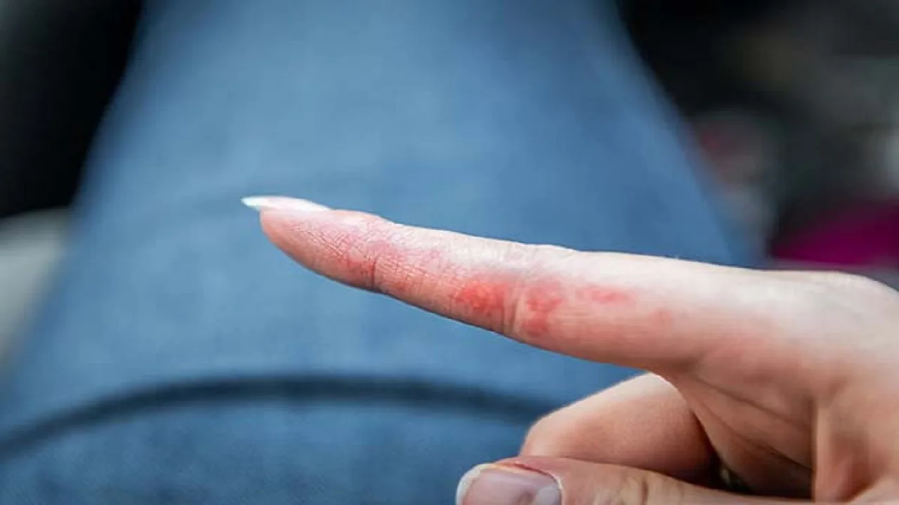 Dry Skin – Symptoms,