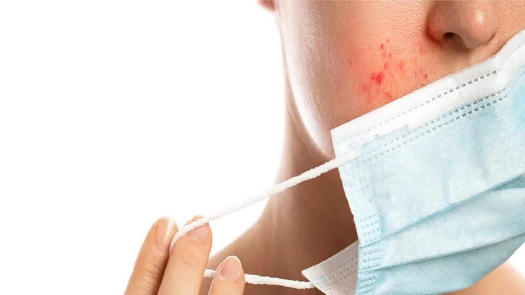Mask Acne (Maskne): What Causes It, How to Recognize It, and How to Reduce It