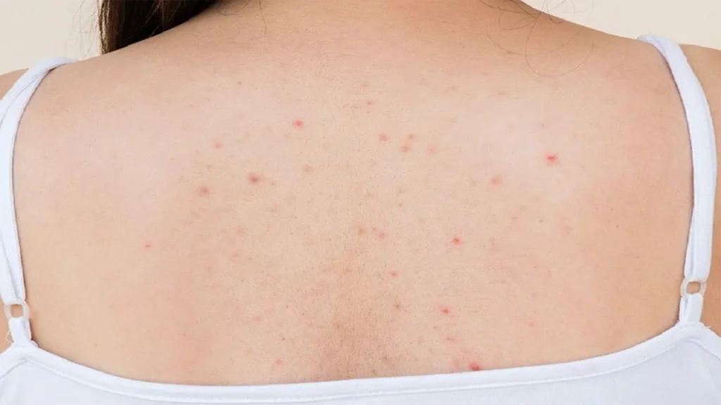 Pimples on the Back: Why They Form and How to Remove Them